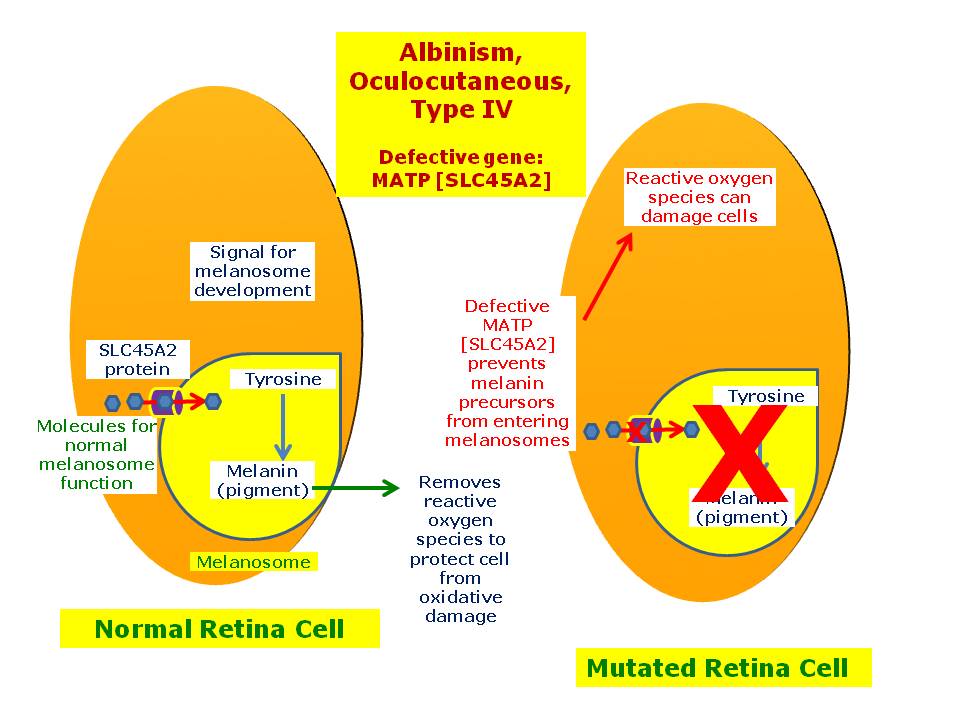 Albinism, Oculocutaneous, Type IV Hereditary Ocular Diseases